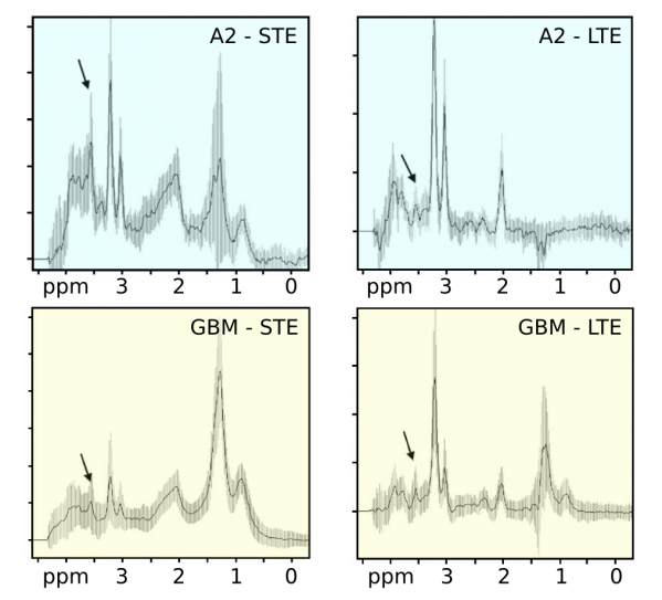 Low-grade astrocytomas (top row, A2) could be distinguished from glioblastomas (bottom row, GBM) by using the relative visibility of myo-inositol and glycine at short and long echo times (LTE vs STE) NMR spectra.